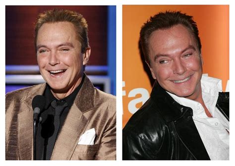 plastic surgery before after david cassidy plastic surgery