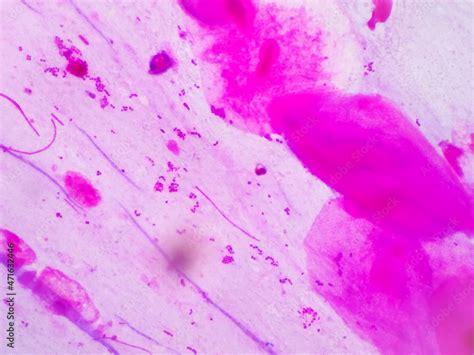 Prostatic Smear For Gram Staining Microscopic 100x Show Neisseria
