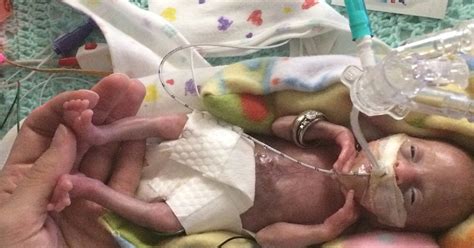 earliest premature baby  delivered    toddler