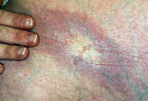 picture of skin diseases and problems morphea late stage