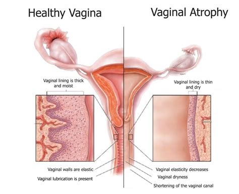 Vaginal Atrophy Specialist Jackson Ms Southeast Urogyn