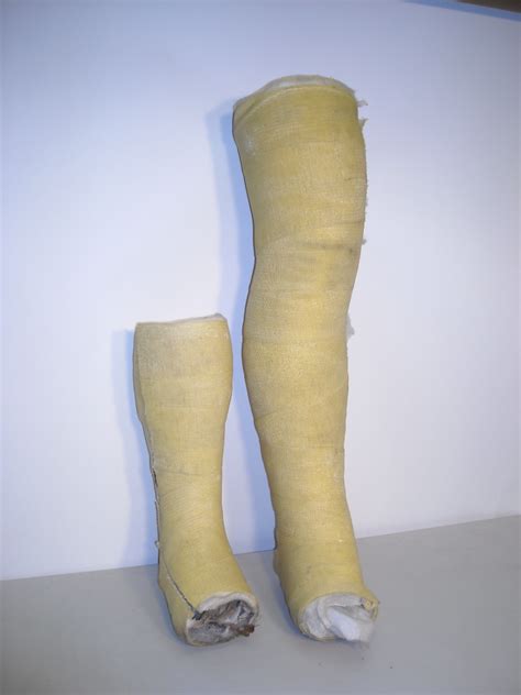 Plaster Cast Leg
