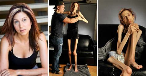 This Anorexic Actress Weighed 40 Pounds And Was About To Die Look At