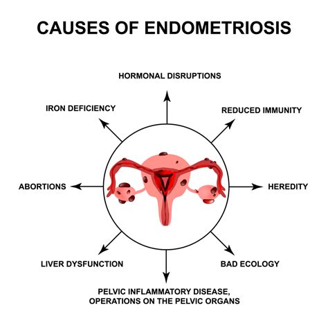 endometriosis   treatment