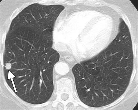dose ct scan  lung cancer  xxx hot girl