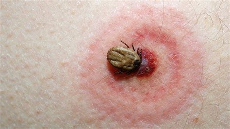 How To Know When You’ve Been Bitten By A Tick Everyday Health