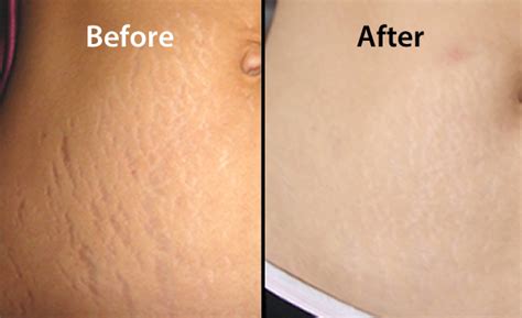 revitol stretch mark cream removal review does the