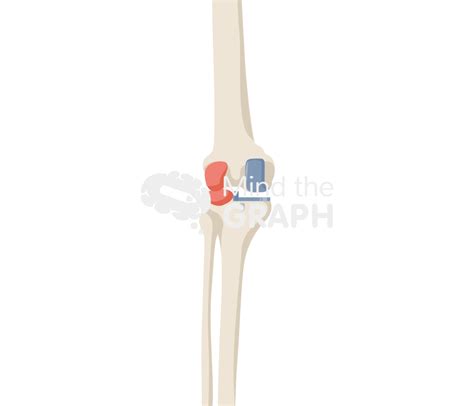 medial unicondylar knee arthroplasty mobile bearing anterior posterior