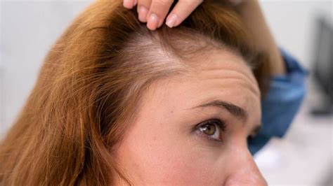 symptoms types  treatment  female pattern baldness onlymyhealth