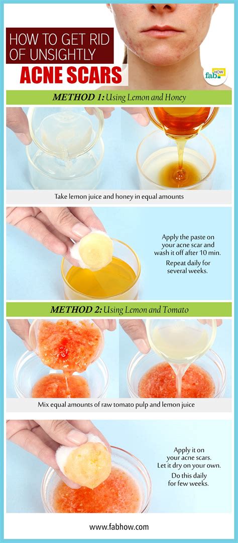 howto how to get rid of acne scars home remedies