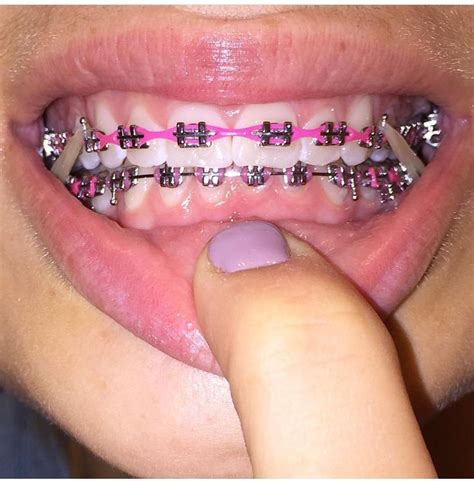 follow ya average girl for more pins ♛ cute braces colors cute braces