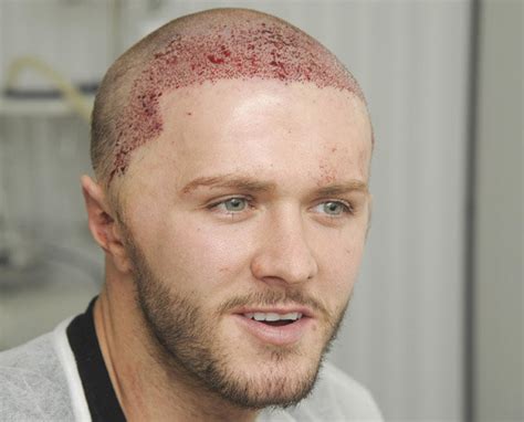 Geordie Shore S Kyle Christie Gets Gruesome Hair Transplant At The Age