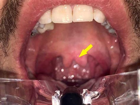 unexpected  unexplained uvula australian doctor group