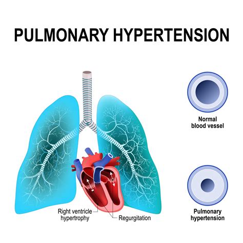 types  pulmonary hypertension