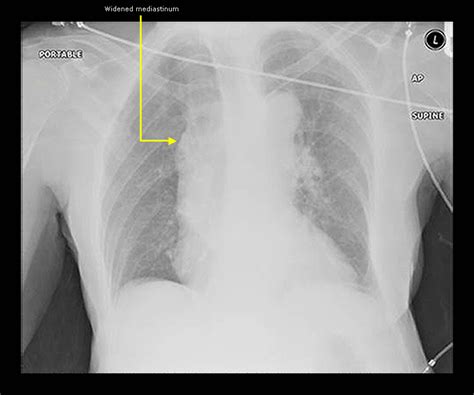Chest Radiography Rcemlearning India