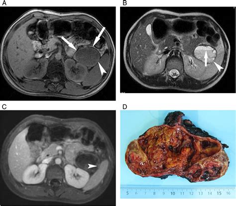 Solid Pseudopapillary Tumor Of The Pancreas Mr Imaging Findings In 21