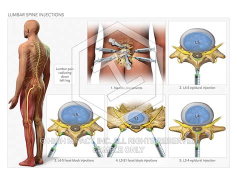 image  lumbar spine injections illustration trial guides