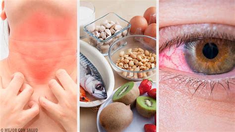 alergia  los aditivos alimentarios sintomas  tratamientos mejor  salud