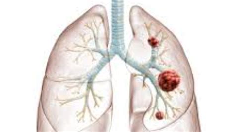 Lung Carcinoid Tumors Symptoms Diagnosis And Treatment