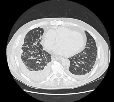 Pleural Effusion Concise Medical Knowledge