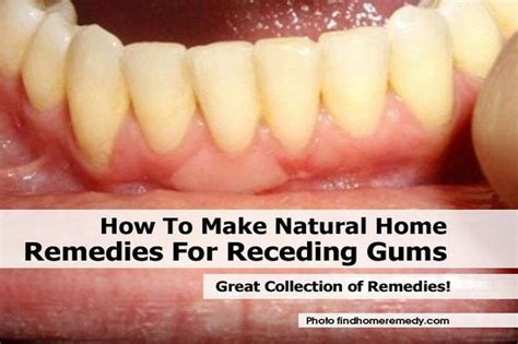 receding gum remedies natural home remedies receding