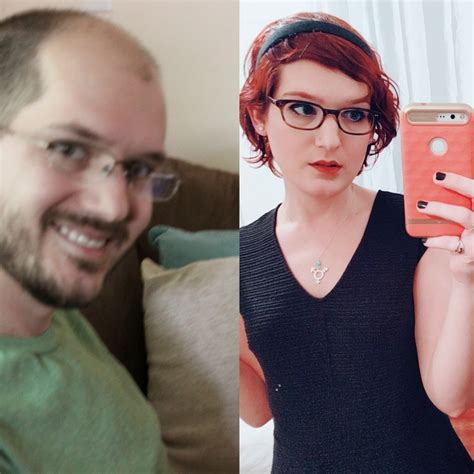 scalp hair regrowth in hormone treated transgender woman