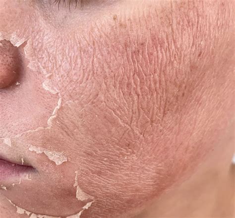 facial chemical peels  allen tx face peeling treatments