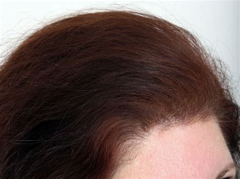 best female hair transplant female before and after hair transplant