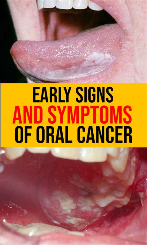 warning signs of oral cancer are you at risk