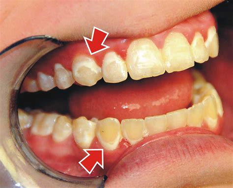 treat white spots  braces   orthodontistcom