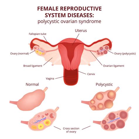 The Ultimate Guide To Polycystic Ovary Syndrome Uears