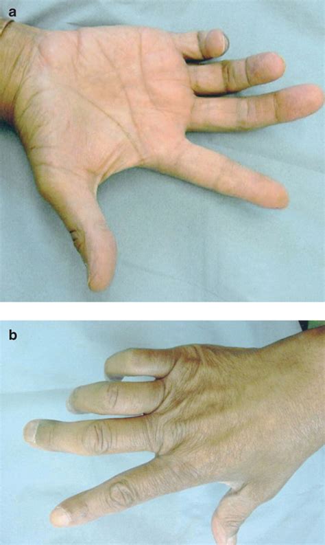 ulnar claw hand  flexion deformity   ring   fingers