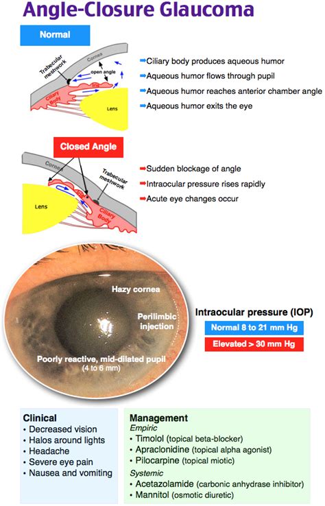 angle closure glaucoma opthalmic technician eye facts eye anatomy