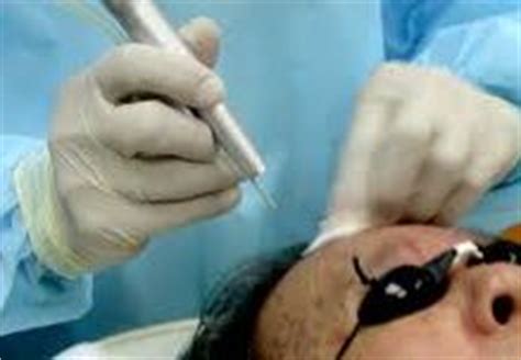 laser mole removal treatment