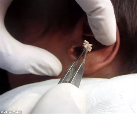 dr vikram yadav treats man with maggot infestation in his ear on video daily mail online
