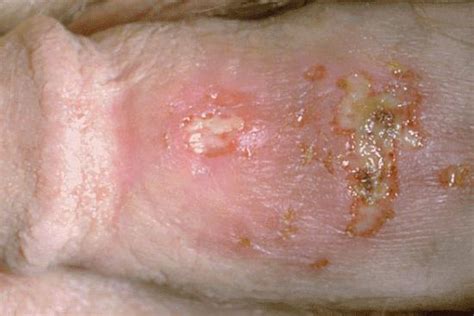 What Does Herpes Look Like Pictures Treatment And