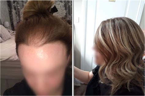 female hair loss   crown    front hairline