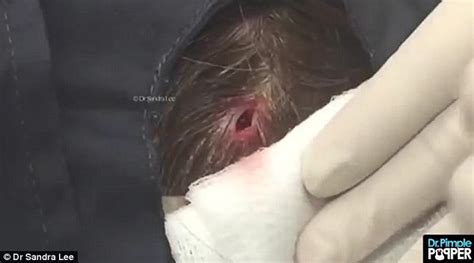 dr pimple popper drags out three revolting cysts from woman s scalp daily mail online