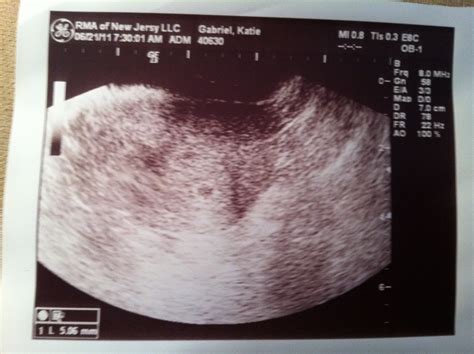 dear hope ultrasound pictures