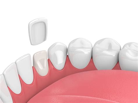the pros and cons of porcelain veneers dr sonny kim reston