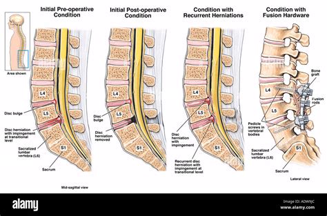 dolor en la parte baja de la espalda 5 l4 y l5 s1 hernias de disco a