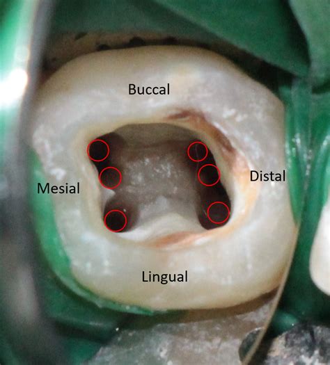 access opening   mandibular molar root canal treatment demo