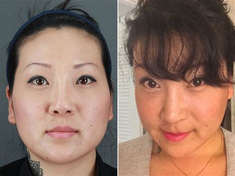 South Korea S Growing Obsession With Cosmetic Surgery