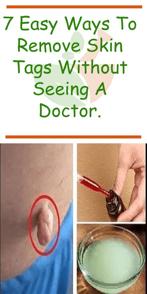 7 easy ways to remove skin tags without visiting a doctor healthy