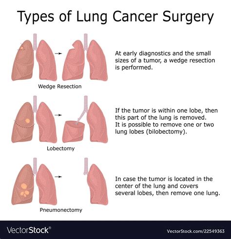 Lung Cancer Surgery Medicine For World