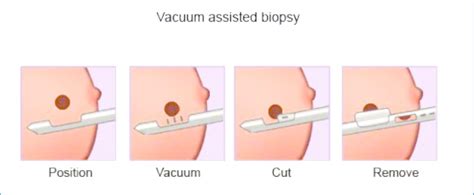 Breast Biopsy How To A Breast Biopsy Test That