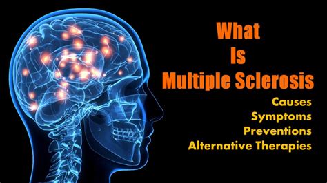 multiple sclerosis system disorder template