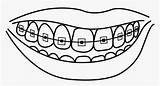 Braces Teeth Coloring Clipart Smile Pages Mouth Template Collection Drawing Transparent Cigar Dental Tooth Webstockreview Clipground Pngitem sketch template