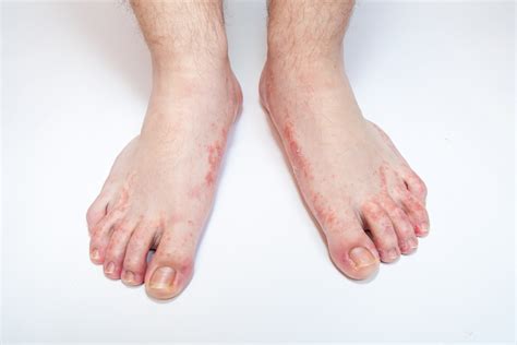 Foot Rash Causes Symptoms Home Remedies And Treatment