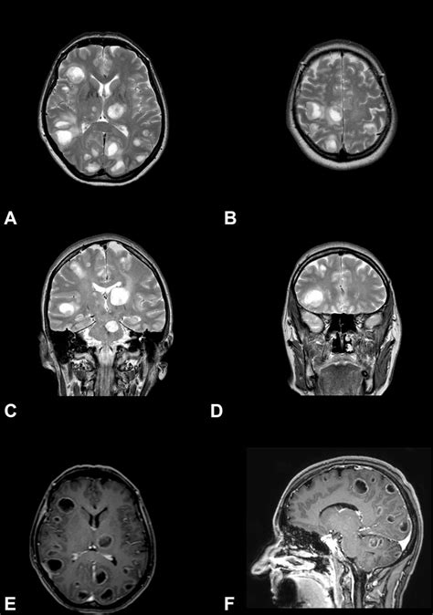 atypical radiological presentation of multiple cystic brain metastases